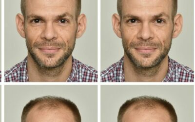 Homme avec différentes calvities et styles de barbe.